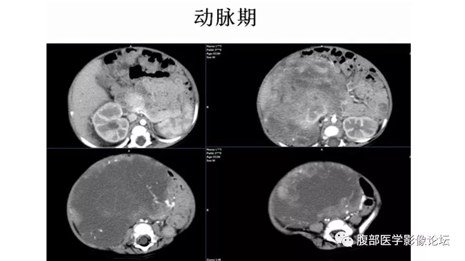 【病例】肾脏透明细胞肉瘤1例CT影像