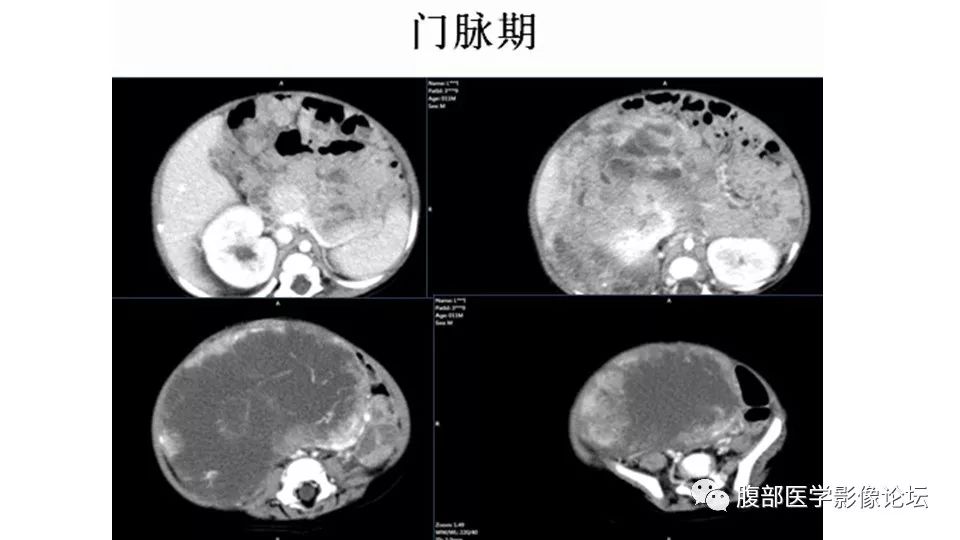 【病例】肾脏透明细胞肉瘤1例CT影像