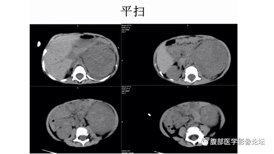 【病例】肾脏横纹肌样瘤1例CT影像