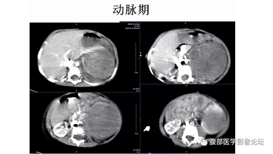 【病例】肾脏横纹肌样瘤1例CT影像