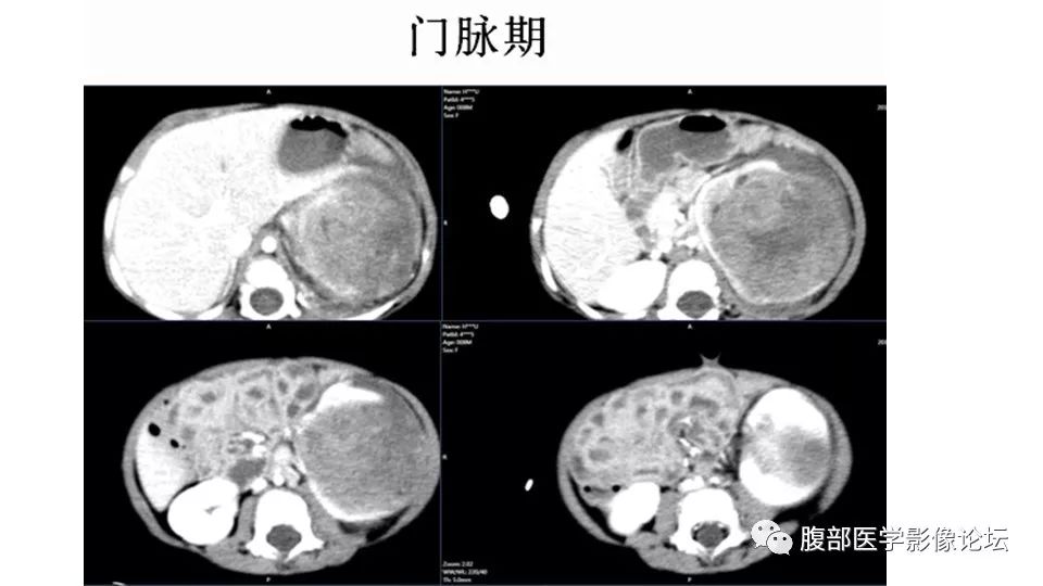 【病例】肾脏横纹肌样瘤1例CT影像