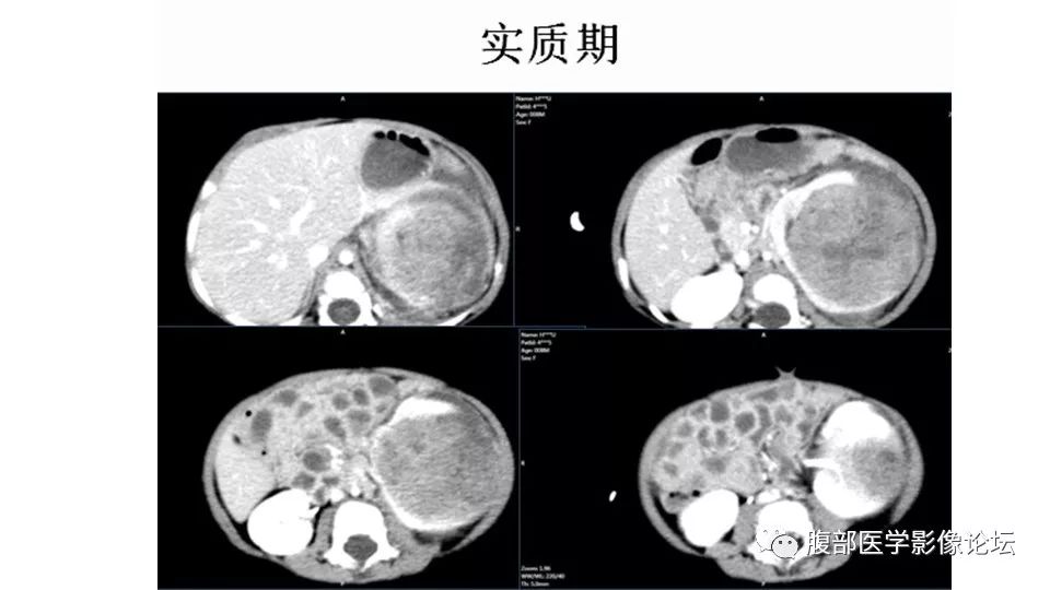 【病例】肾脏横纹肌样瘤1例CT影像