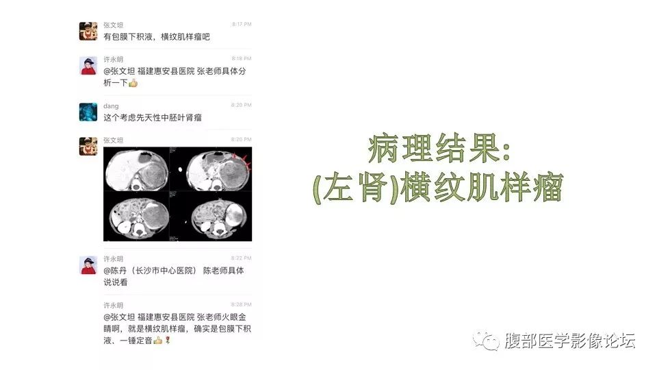 【病例】肾脏横纹肌样瘤1例CT影像