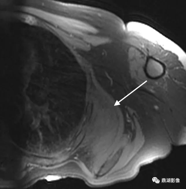 【病例】背部弹力纤维瘤超典型影像表现 【病例】背部弹力纤维瘤超典型影像表现