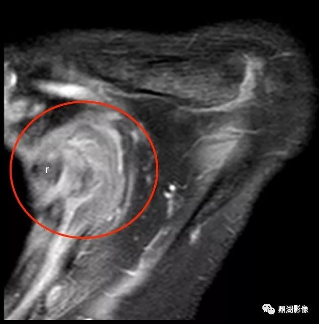 【病例】背部弹力纤维瘤超典型影像表现 【病例】背部弹力纤维瘤超典型影像表现