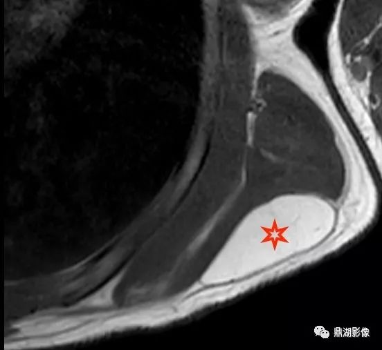【病例】背部弹力纤维瘤超典型影像表现 【病例】背部弹力纤维瘤超典型影像表现