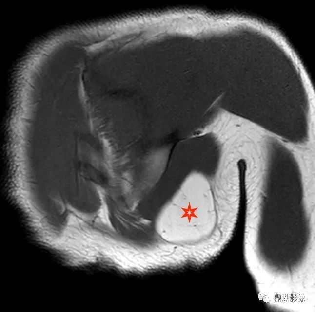 【病例】背部弹力纤维瘤超典型影像表现 【病例】背部弹力纤维瘤超典型影像表现