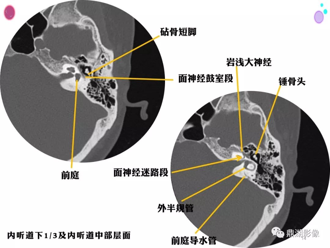 【PPT】颞骨断层解剖及CT三维重建