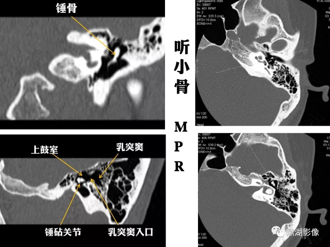 【PPT】颞骨断层解剖及CT三维重建