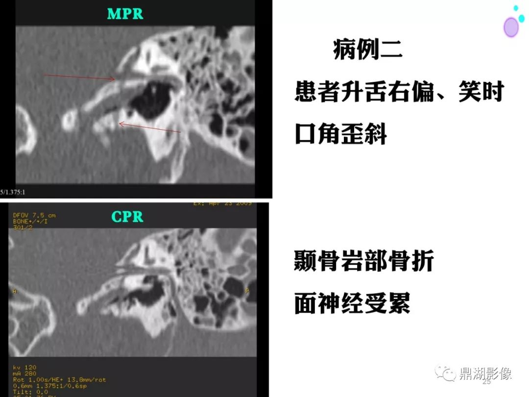 【PPT】颞骨断层解剖及CT三维重建