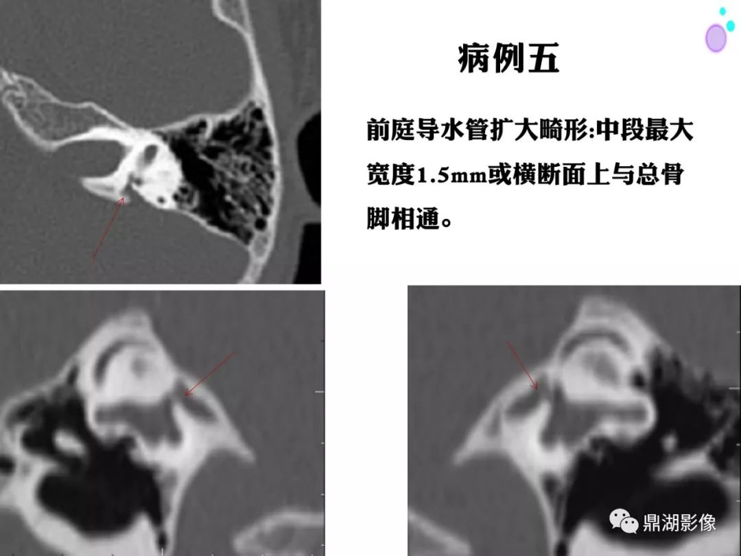 【PPT】颞骨断层解剖及CT三维重建