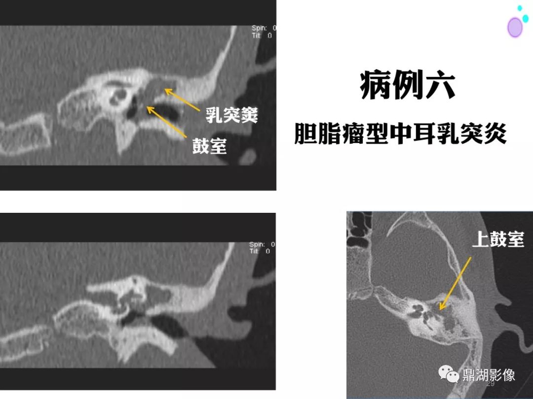 【PPT】颞骨断层解剖及CT三维重建