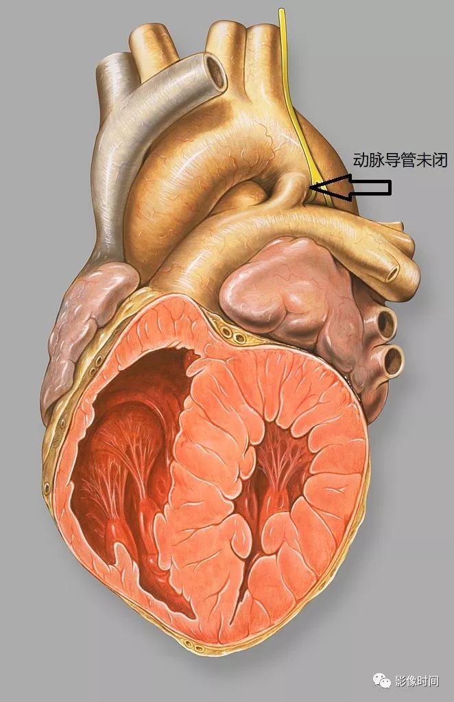 动脉导管未闭影像诊断要点 动脉导管未闭影像诊断要点