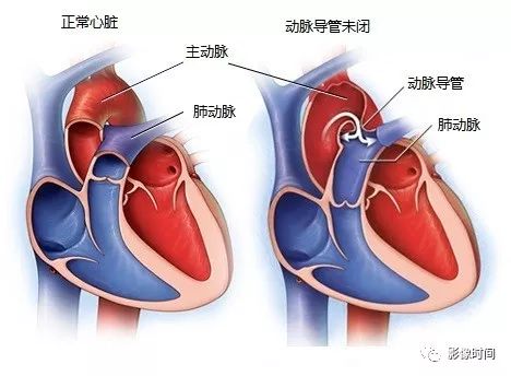 动脉导管未闭影像诊断要点 动脉导管未闭影像诊断要点