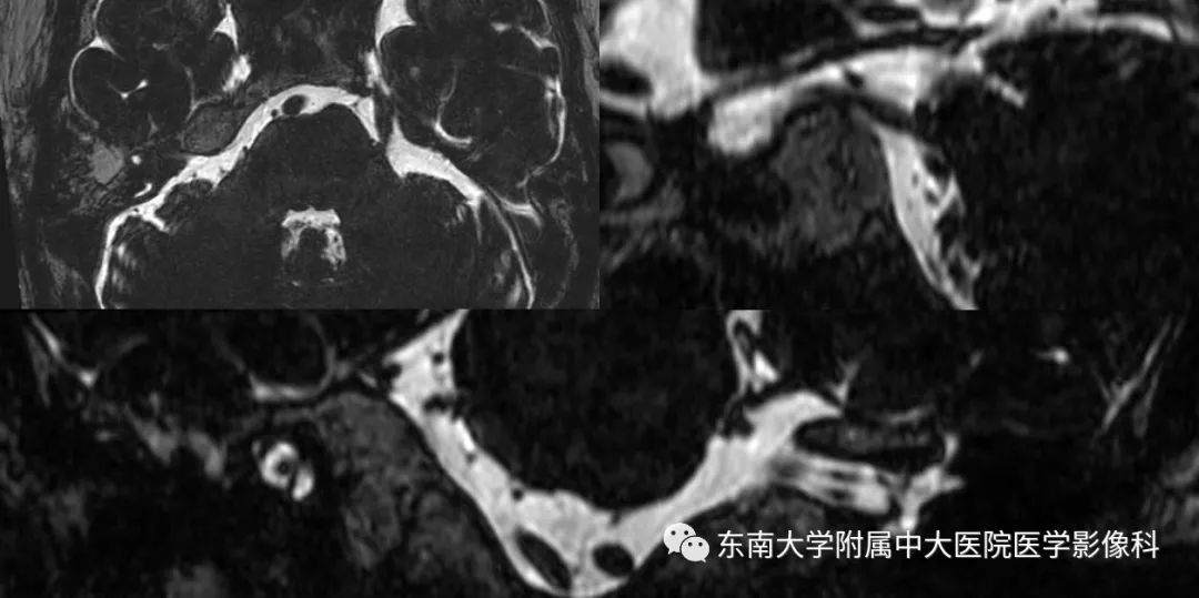 【PPT】颅神经血管压迫综合征