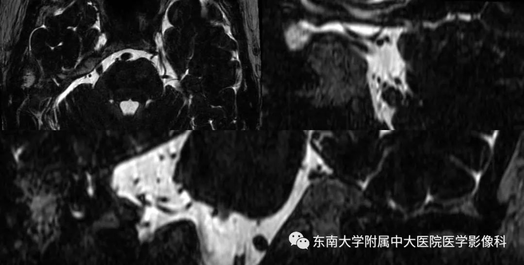 【PPT】颅神经血管压迫综合征