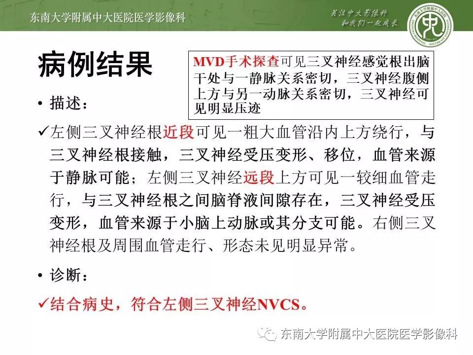 【PPT】颅神经血管压迫综合征