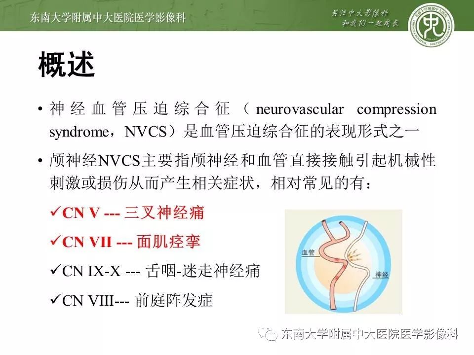 【PPT】颅神经血管压迫综合征