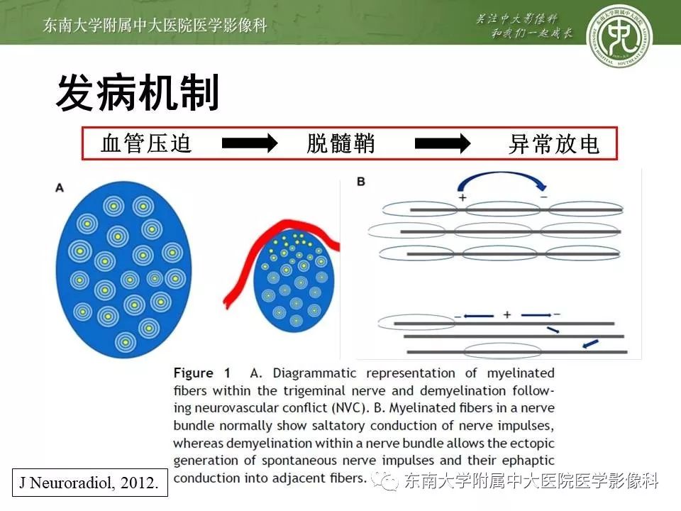 【PPT】颅神经血管压迫综合征