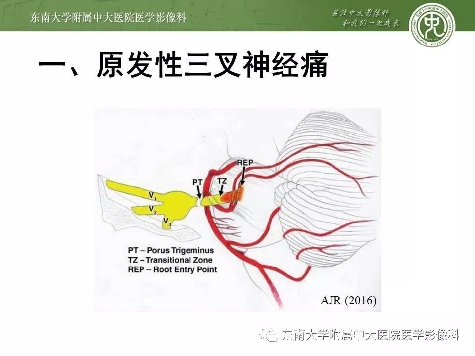 【PPT】颅神经血管压迫综合征