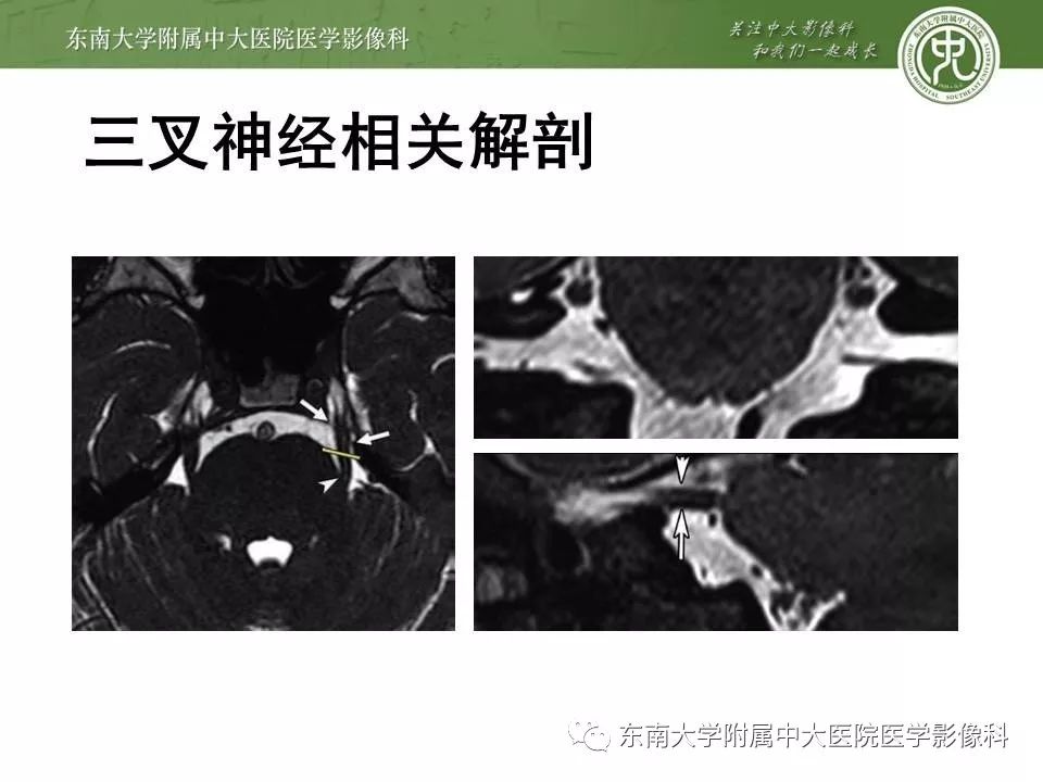 【PPT】颅神经血管压迫综合征