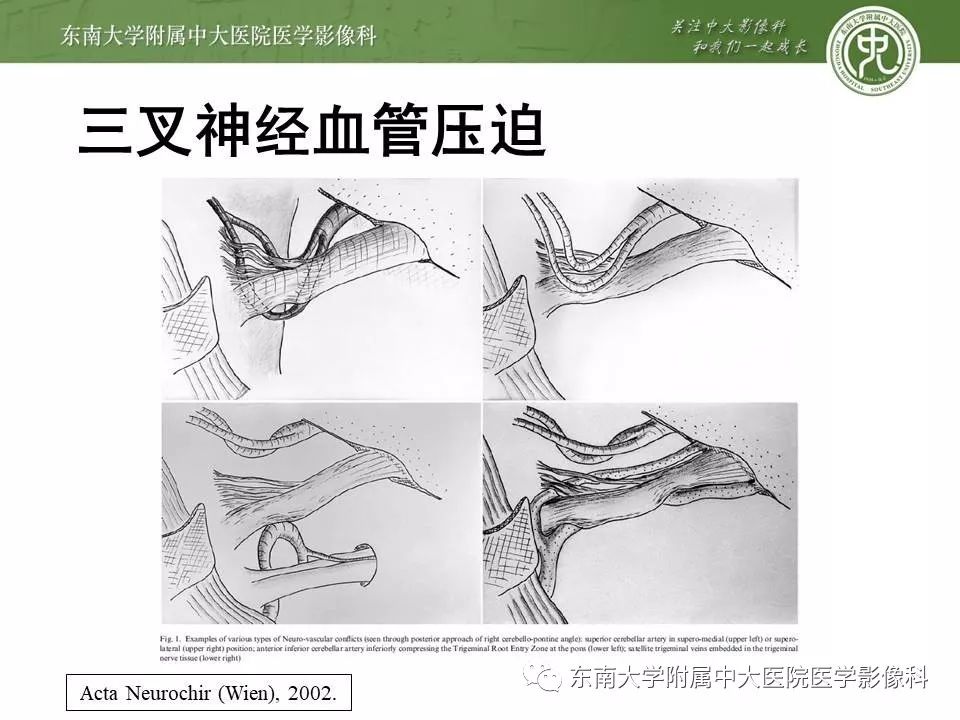 【PPT】颅神经血管压迫综合征