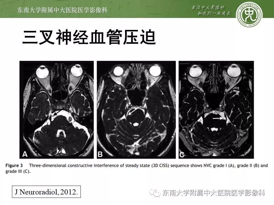 【PPT】颅神经血管压迫综合征