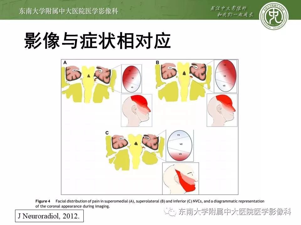【PPT】颅神经血管压迫综合征