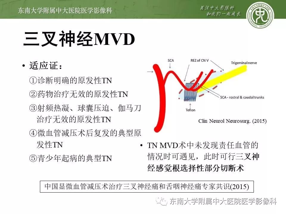 【PPT】颅神经血管压迫综合征