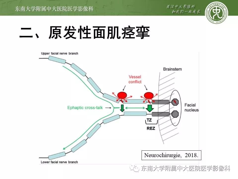 【PPT】颅神经血管压迫综合征