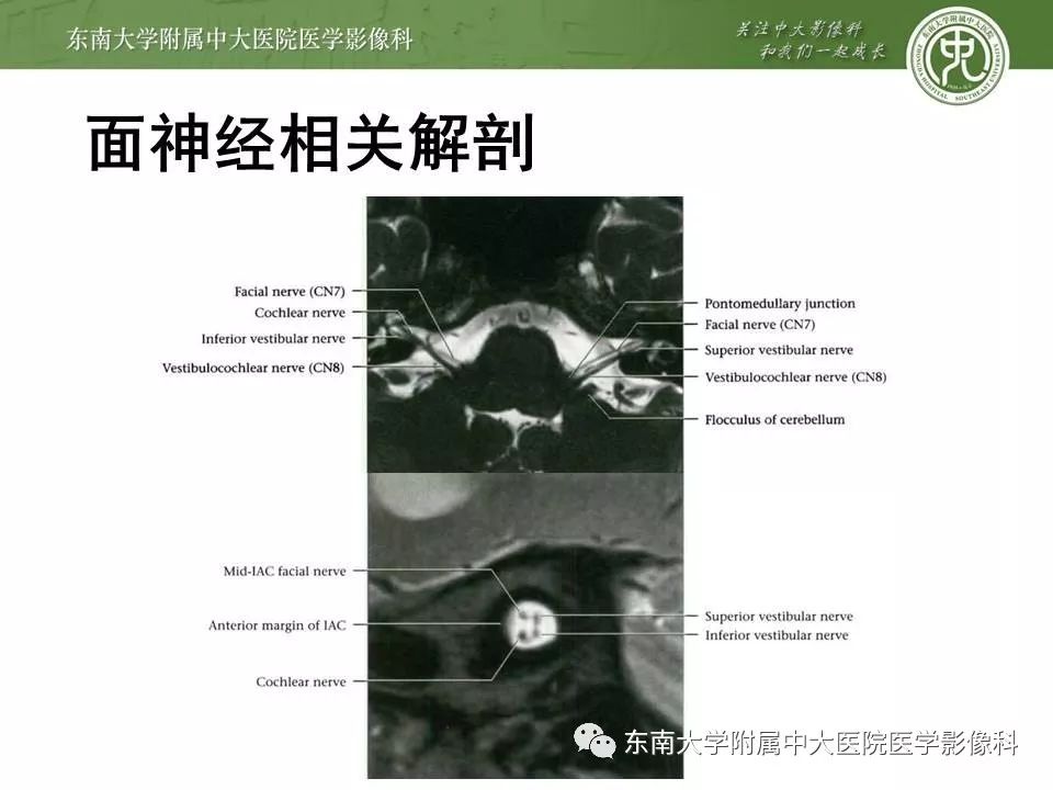 【PPT】颅神经血管压迫综合征