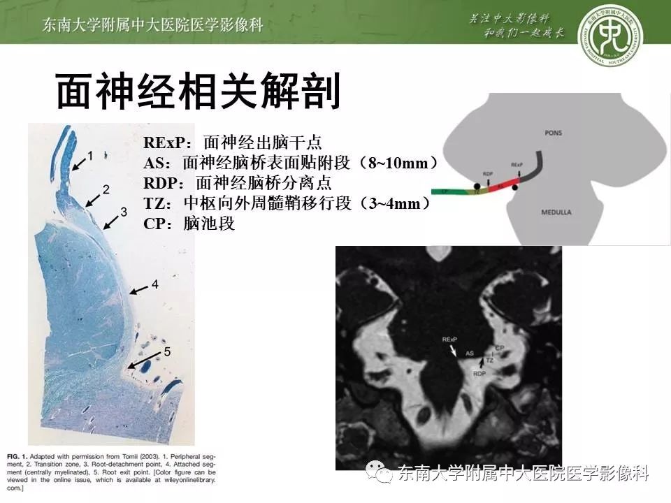 【PPT】颅神经血管压迫综合征