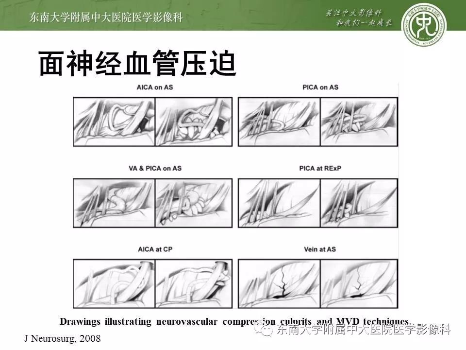 【PPT】颅神经血管压迫综合征