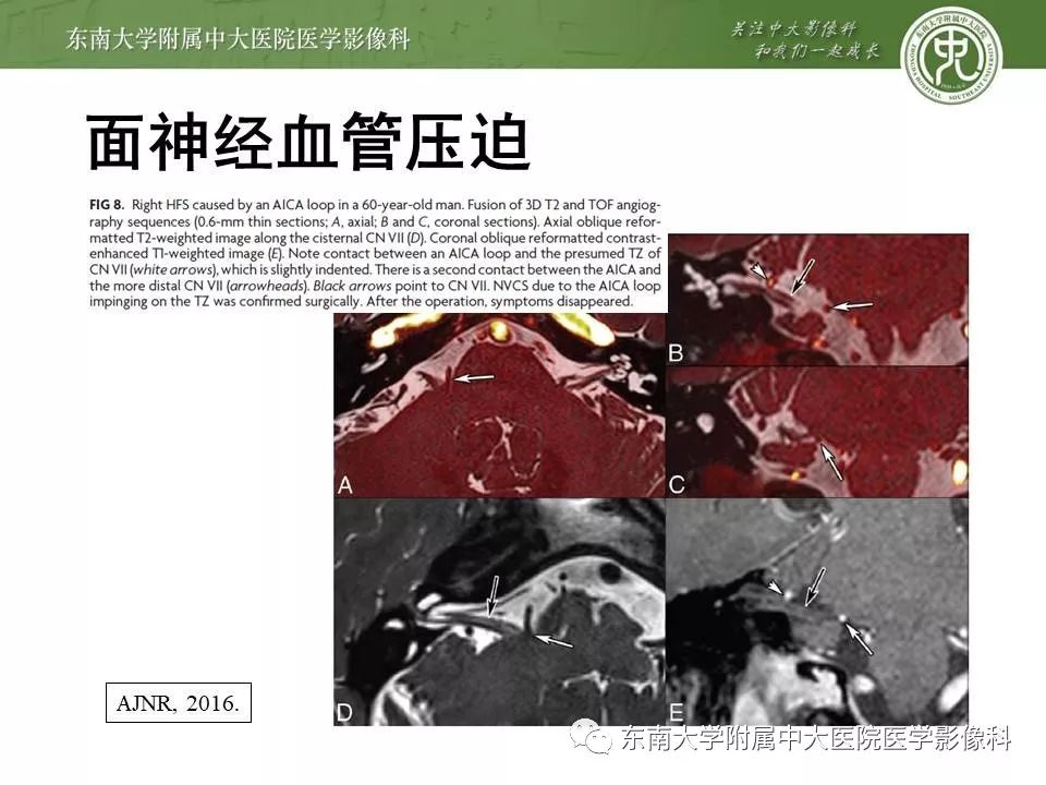 【PPT】颅神经血管压迫综合征