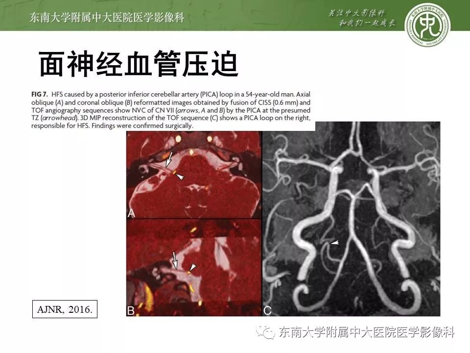 【PPT】颅神经血管压迫综合征