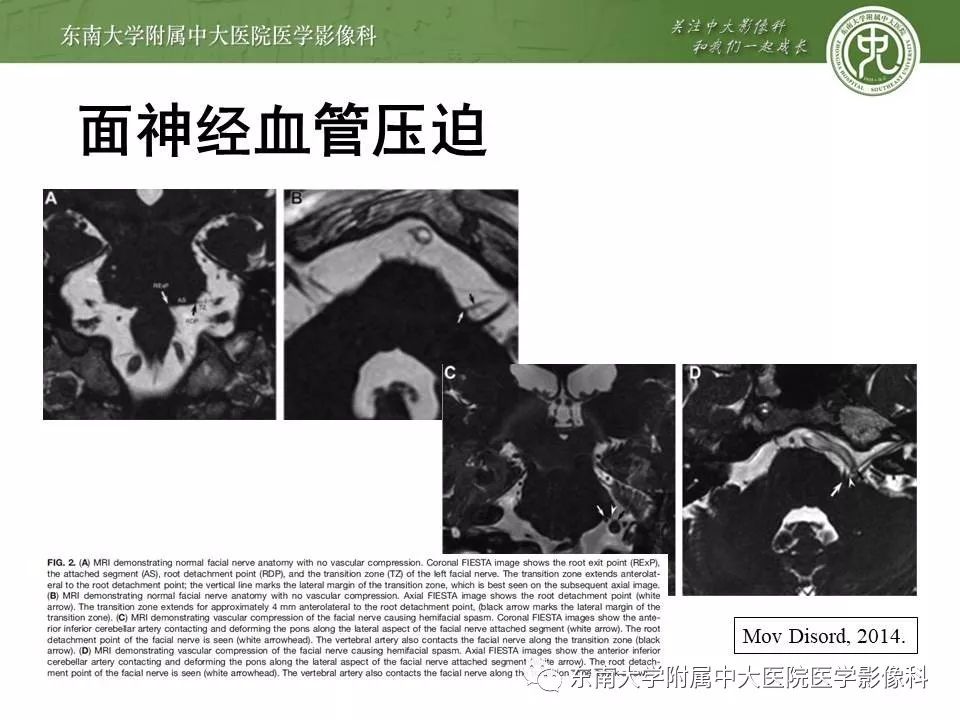【PPT】颅神经血管压迫综合征