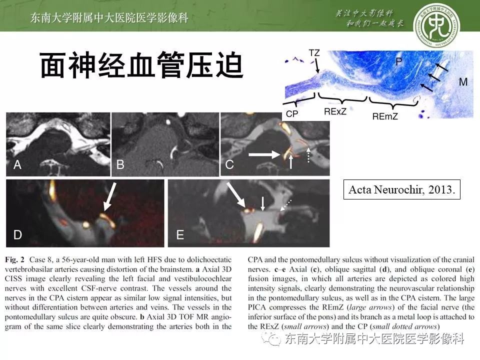 【PPT】颅神经血管压迫综合征