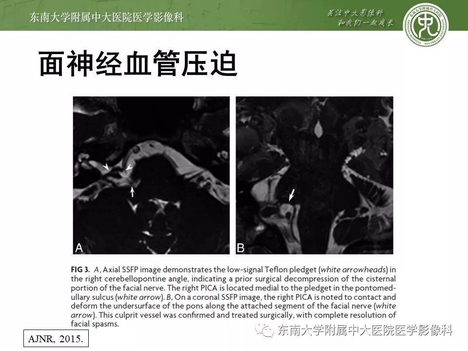 【PPT】颅神经血管压迫综合征