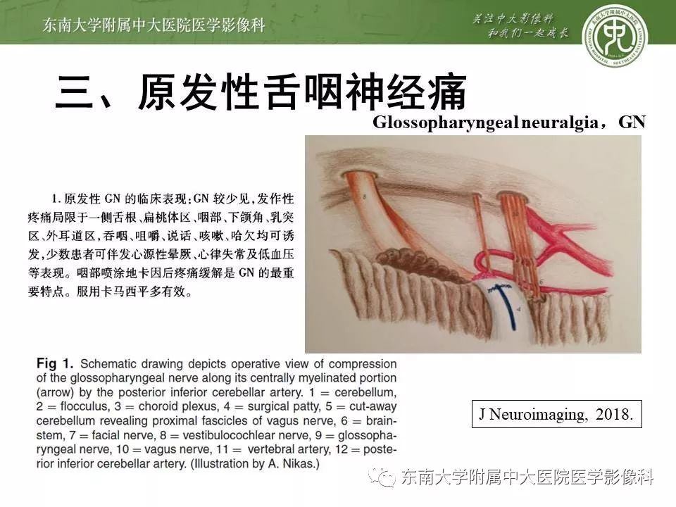 【PPT】颅神经血管压迫综合征