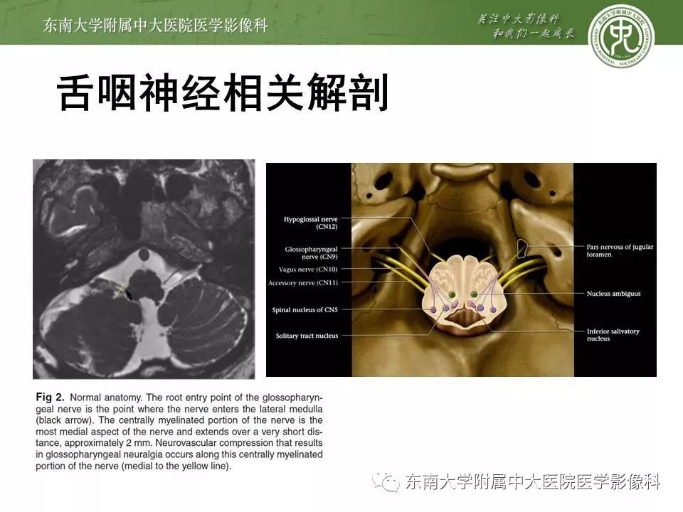【PPT】颅神经血管压迫综合征