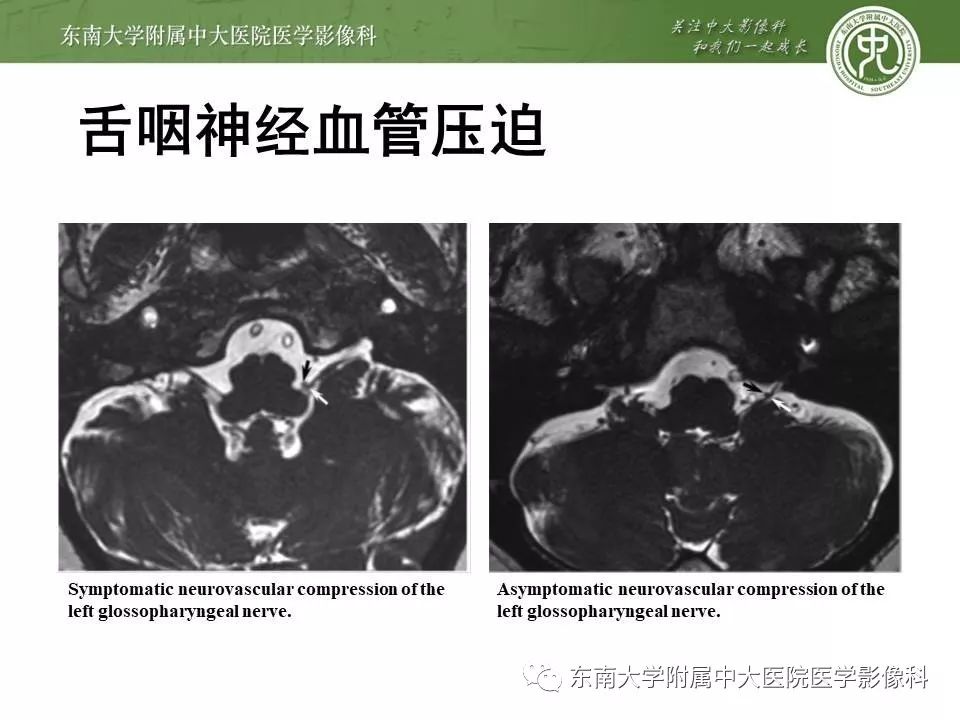 【PPT】颅神经血管压迫综合征