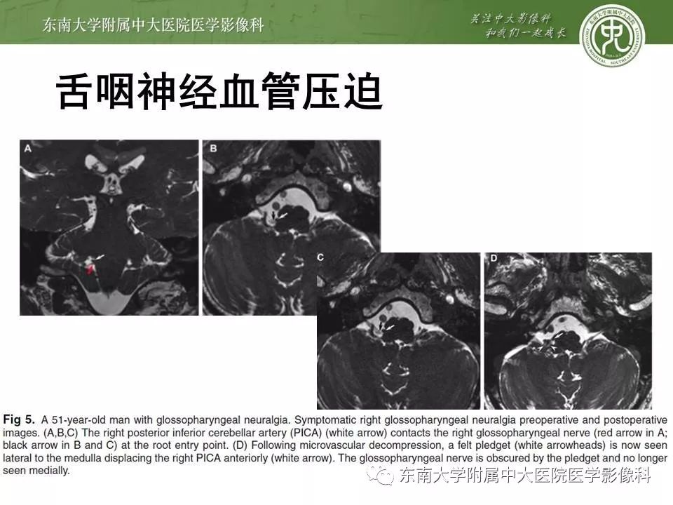 【PPT】颅神经血管压迫综合征