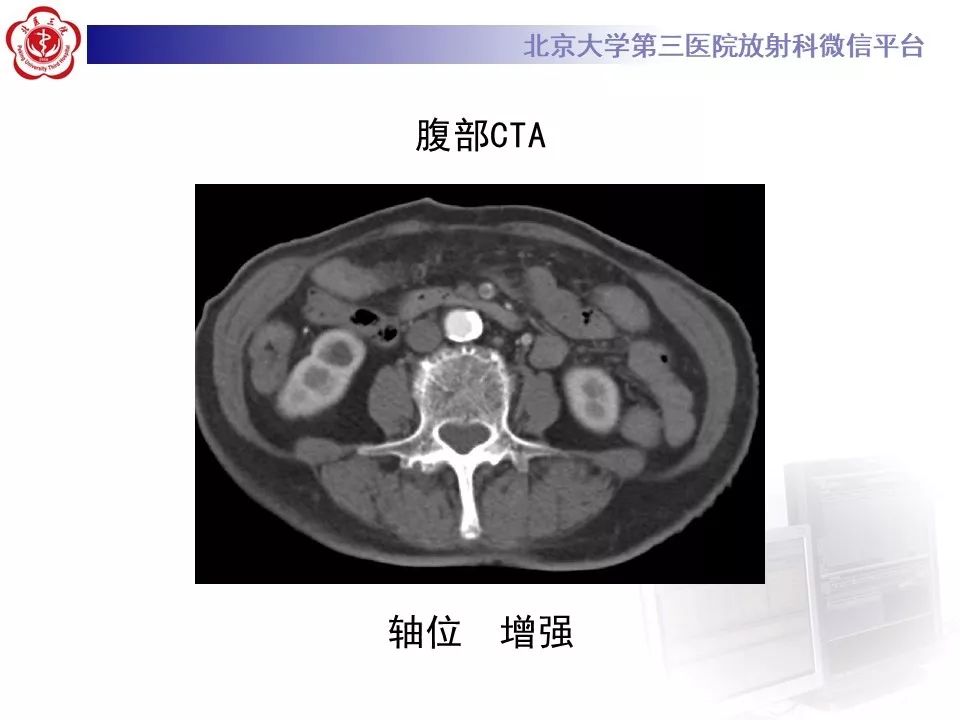 【PPT】肠系膜上动脉栓塞