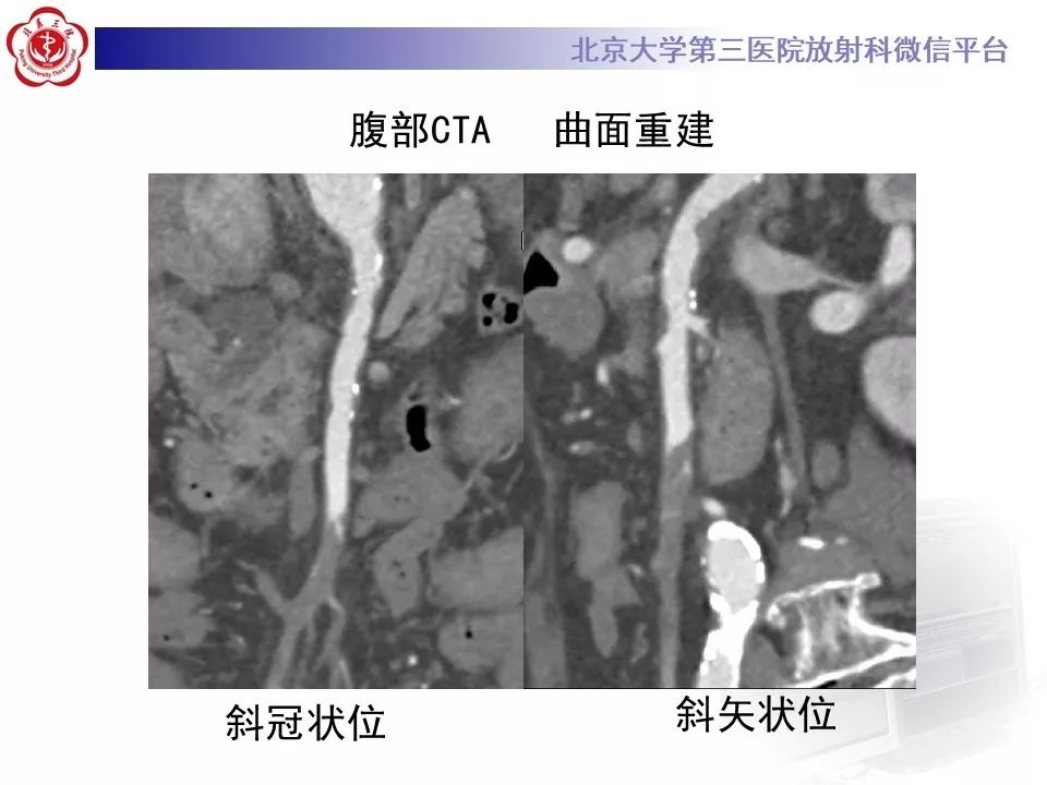 【PPT】肠系膜上动脉栓塞