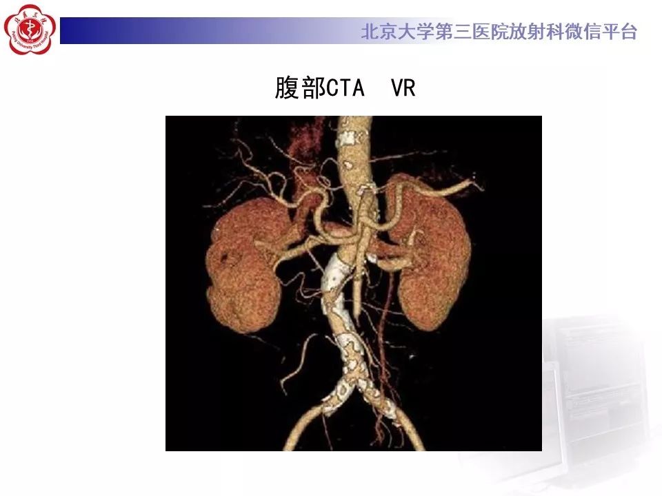 【PPT】肠系膜上动脉栓塞