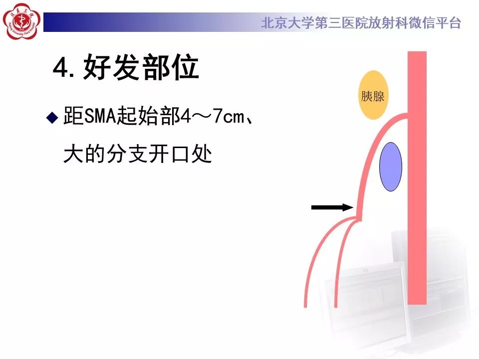 【PPT】肠系膜上动脉栓塞