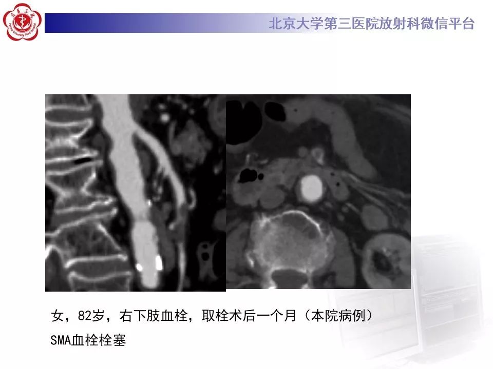 【PPT】肠系膜上动脉栓塞