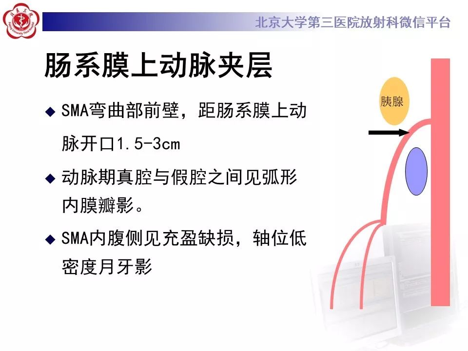 【PPT】肠系膜上动脉栓塞