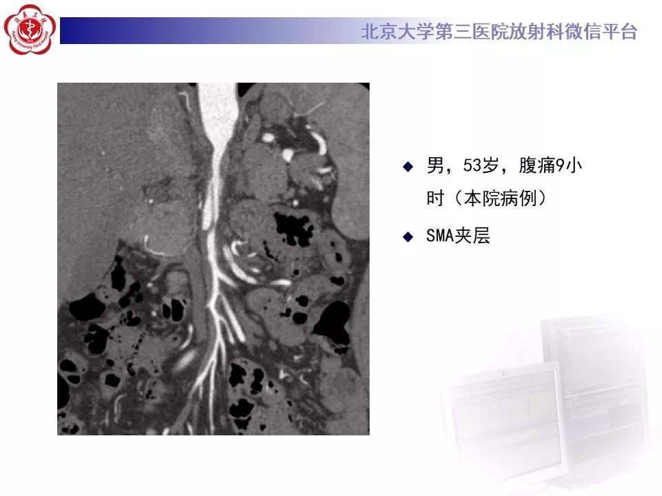【PPT】肠系膜上动脉栓塞