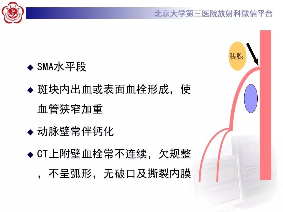 【PPT】肠系膜上动脉栓塞